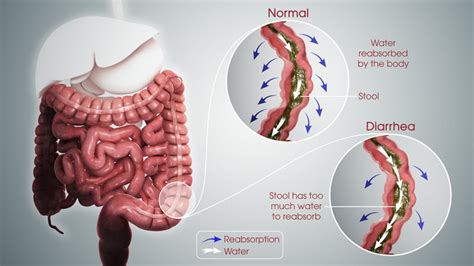 Diarrhea | Getcured Apothecary Pvt Ltd