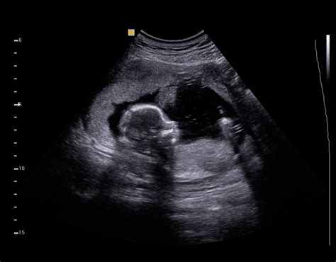 Ultrasounds Sex Of Baby - Amauter Gay