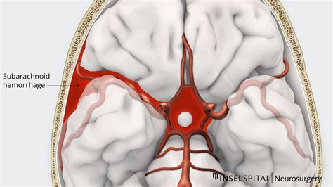 Ruptured aneurysm and subarachnoid haemorrhage | Neurosurgery ...