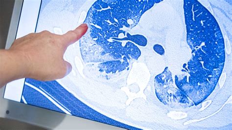 Coronavirus lung scans are a puzzle for doctors