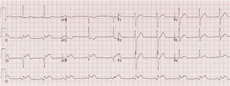 Inferior STEMI • LITFL • ECG Library Diagnosis