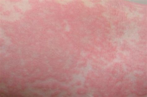 Allergy Reaction Rash - Pictures, Treatment, Causes, Symptoms | Med Mum