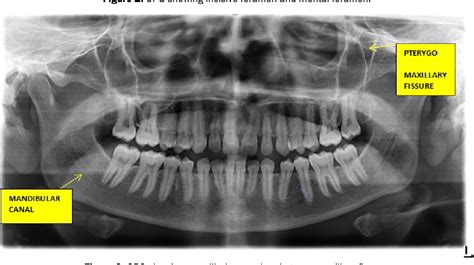 Table 1 from Visibility of Maxillary and Mandibular Anatomical ...