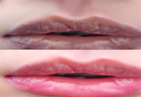 BOTOx lIP FlIP Vs FIllER - Infrared for Health