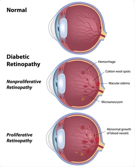 Diabetic eye disease / diabetic retinopathy stages