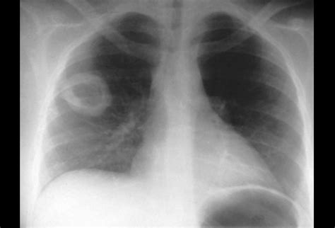 Useful mnemonic for differentials of a cavitating lung lesion | Antrim ...