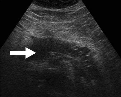 Imaging of Acute Pancreatitis | AJR