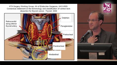 Surgical Treatment for Papillary Thyroid Cancer | Contra Central Neck ...