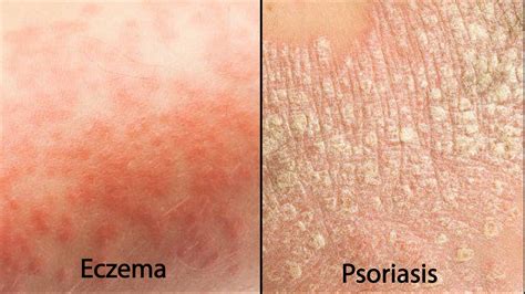 Eczema vs Psoriasis – Which One Do I Have? – Ultra Bee™