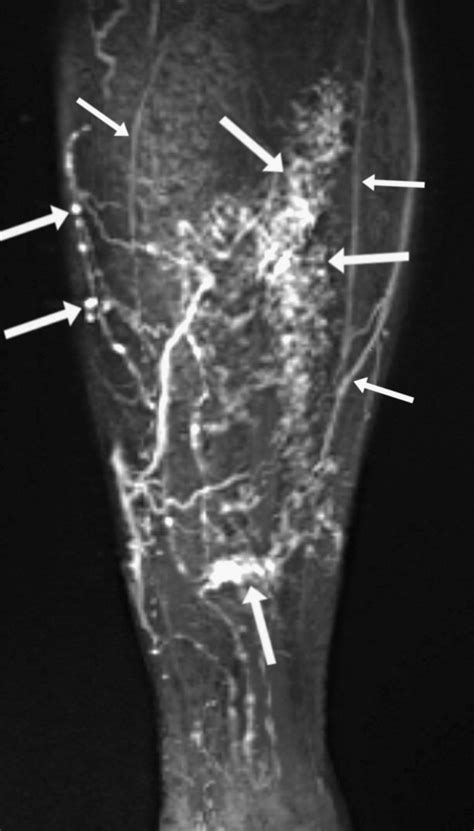 Assessment of the lymphatic system in patients with diffuse ...