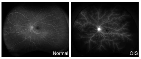 IJMS | Free Full-Text | Ocular Ischemic Syndrome and Its Related ...