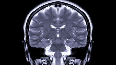 BRAIN TUMOURS AND MRI - Mayfair Diagnostics