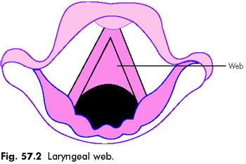 MEDICAL IMAGES: Laryngeal web