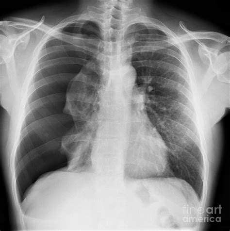 Pneumothorax, X-ray Photograph by Science Photo Library