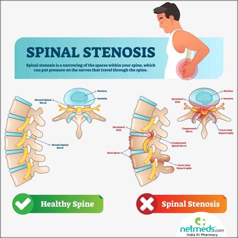 Spinal Stenosis - Causes, Symptoms and Treatment | Netmeds