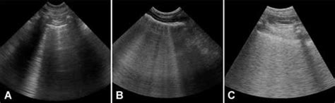 Figure 7 from Frequency and number of ultrasound lung rockets (B-lines ...