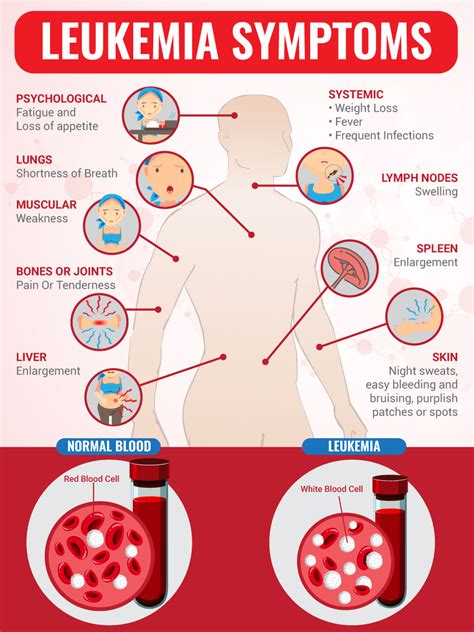 Leukemia Children Symptoms