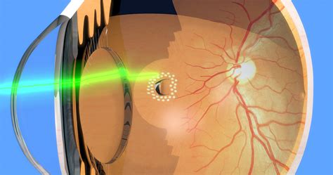 Panretinal Photocoagulation | Eye Patient