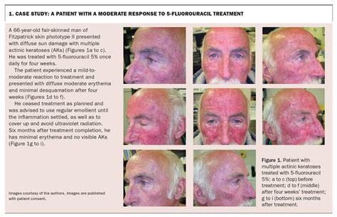 Management Pearls On The Treatment Of Actinic Keratoses And, 57% OFF