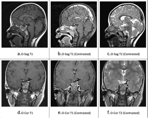 The sella magnetic resonance imaging (MRI) of the patient. The MRI ...