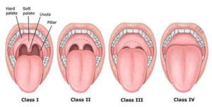 Mallampati classification, class and scale