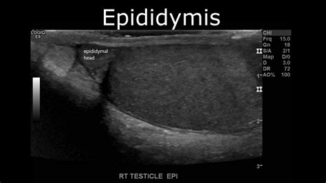 Scrotal Anatomy Ultrasound