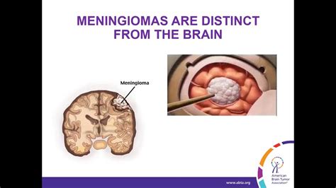 WEBINAR: Treatment Strategies for Meningioma - YouTube