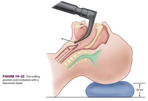 Techniques of Direct and Indirect Laryngoscopy & Intubation