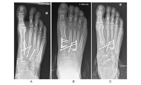 (A) Primary arthrodesis of the 3 medial TMT joints. (B) Temporary ...