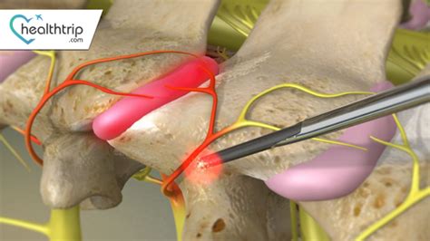 Neurolysis: A Surgical Symphony for Nerve Health | HealthTrip