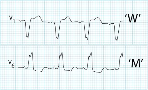 Left Bundle Branch Block (LBBB) • LITFL • ECG Library Diagnosis