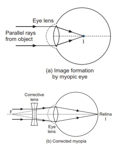 Myopia Ray Diagram