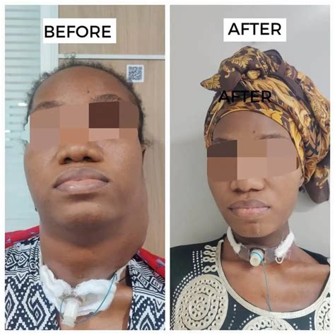 Nigerian Woman's Neck Tumor Surgery: A Landmark Procedure | HOSPIDIO