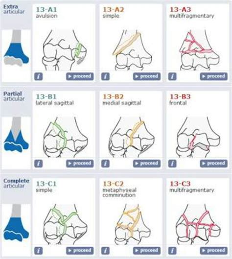 Humerus Supracondyler Fracture Classification | Medical school studying ...