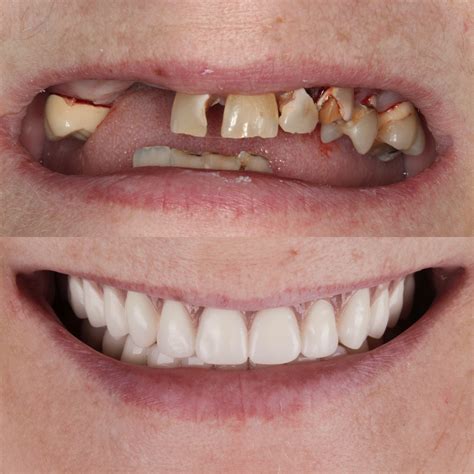 Dentures to replace missing teeth | Knoxville Family Dentistry