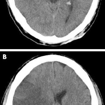 Diffusion-perfusion mismatch in sub-six hour acute stroke. (A) DWI ...