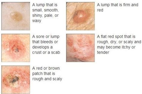 Skin Cancer On Face Early Signs