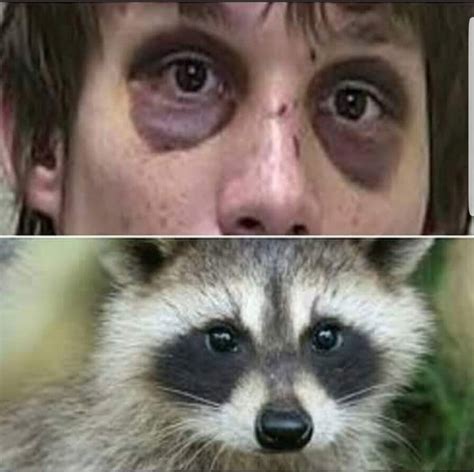 RACCOON EYES I BRAIN INJURY I WRONGFUL DEATH I CASE STUDY, 51% OFF