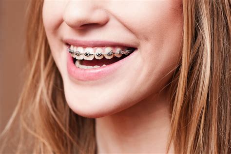 FAQs About Traditional Braces’ Colors in Roseville, CA