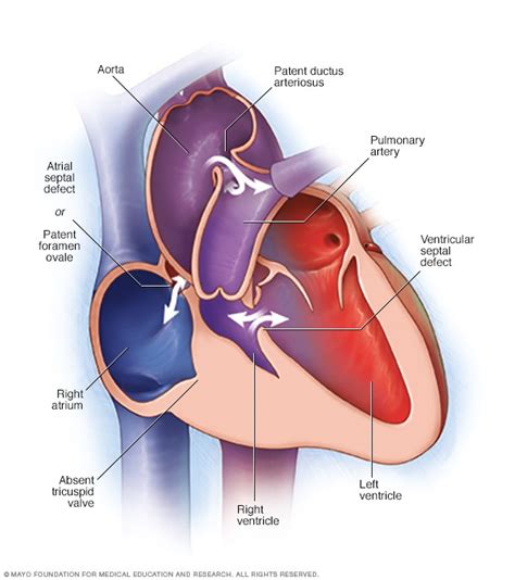 Atresia tricuspídea - Médicos en Merida