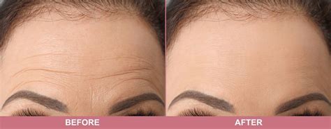 Top Treatment Options For Forehead Wrinkles in Vaughan - Toronto Laser ...