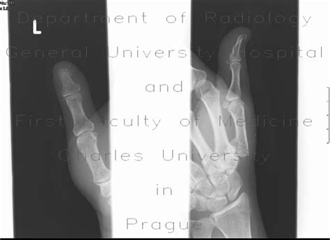 Radiology case: Bennett's fracture