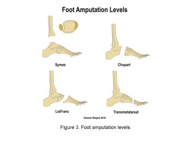 Principles of amputation - Physiopedia