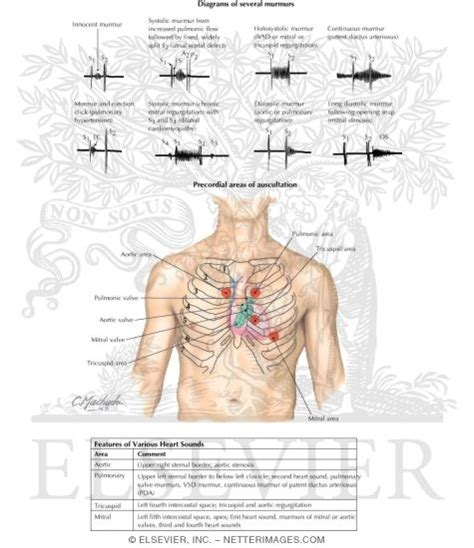 Cardiac Auscultation: Precordial Areas of Auscultation