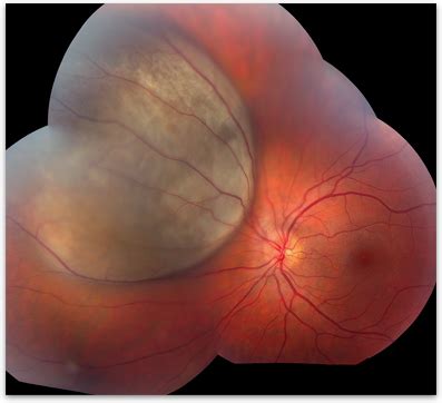 Choroidal Melanoma - Retina-Vitreous Surgeons of CNY