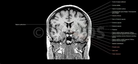 Brain - Coronal section:Basal nuclei and related structures, Corpus ...