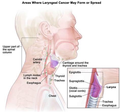 Total or partial laryngectomy procedure, complications, risks & recovery