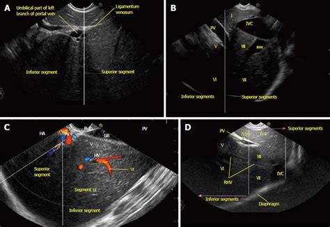 Liver Segment 7 Ultrasound