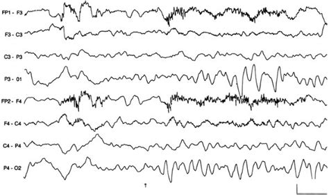 Normal Versus Abnormal Eeg