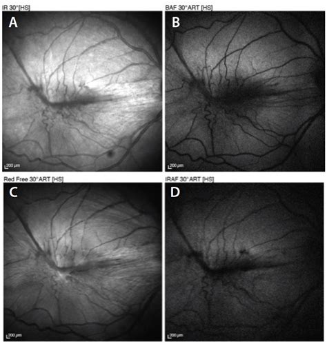 Epiretinal Membrane Surgery: To Peel or Not to Peel the ILM? - Retina Today